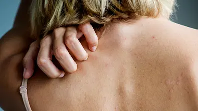 Nahaufnahme einer nicht erkennbaren Frau, die sich den Rücken kratzt - Foto: Rawpixel/iStock