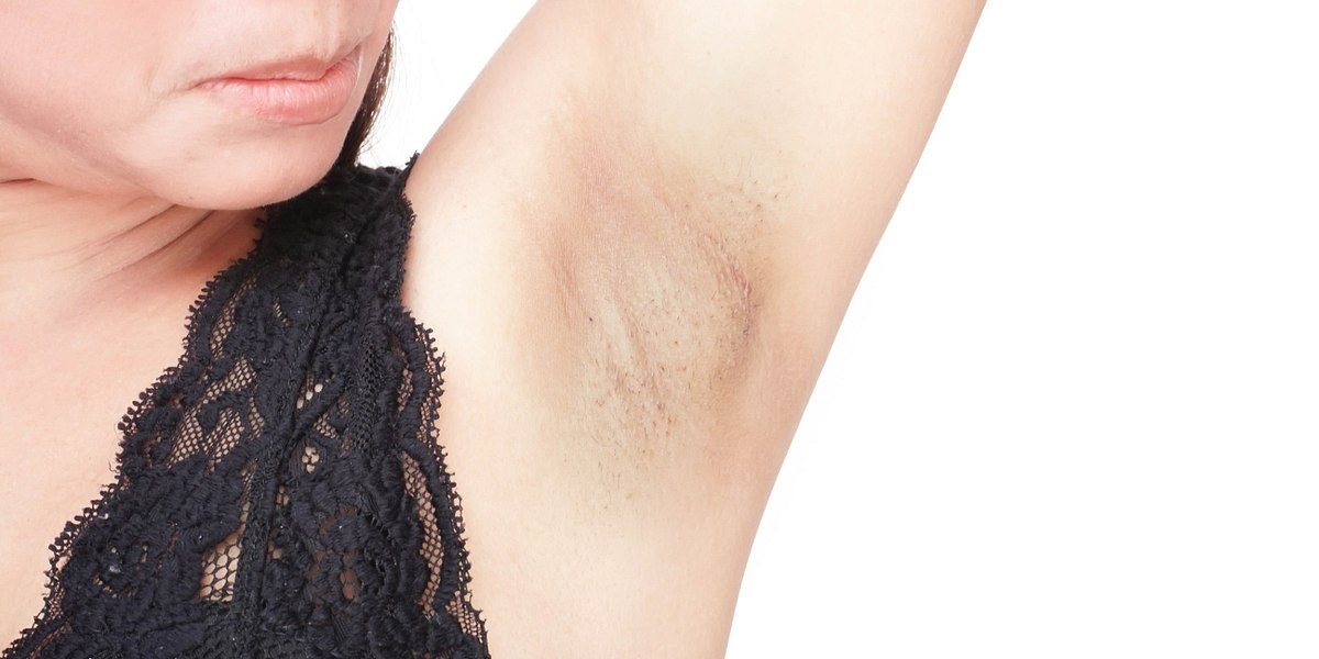 Women problem black armpit on white background for skin care and beauty concept