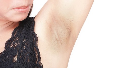 Women problem black armpit on white background for skin care and beauty concept - Foto: Mintra Kwthijak/iStock