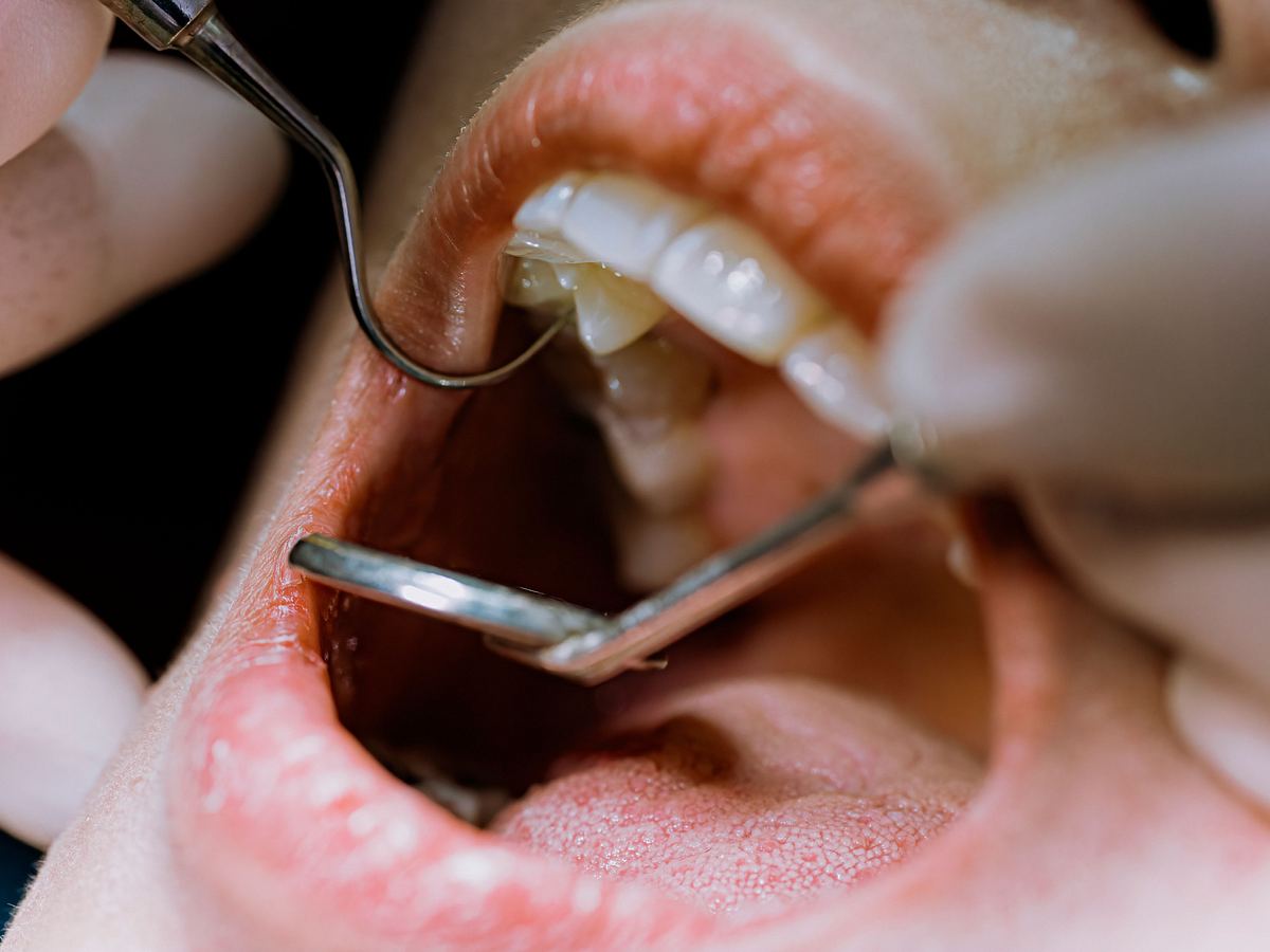 Nahaufnahme eines offenen Mundes bei einer Untersuchung beim Zahnarzt.