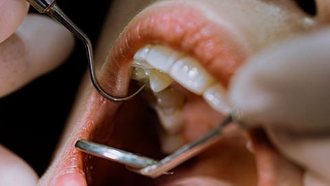 Nahaufnahme eines offenen Mundes bei einer Untersuchung beim Zahnarzt. - Foto: Edwin Tan/iStock