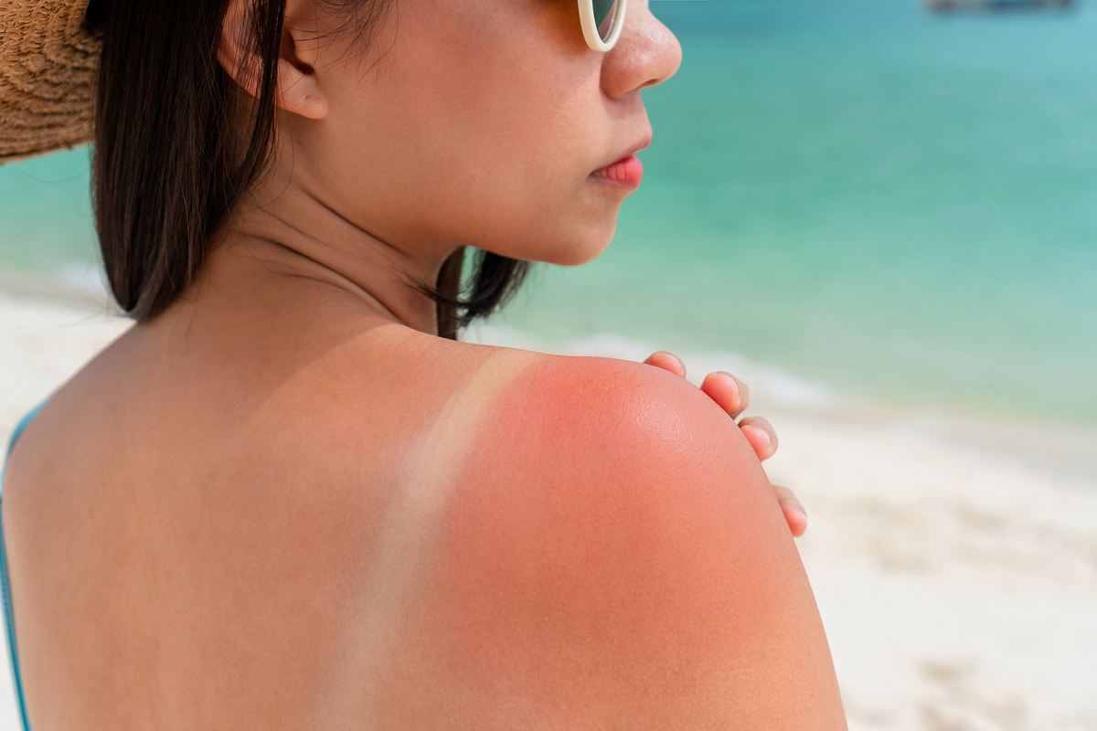Frau mit Sonnenbrand