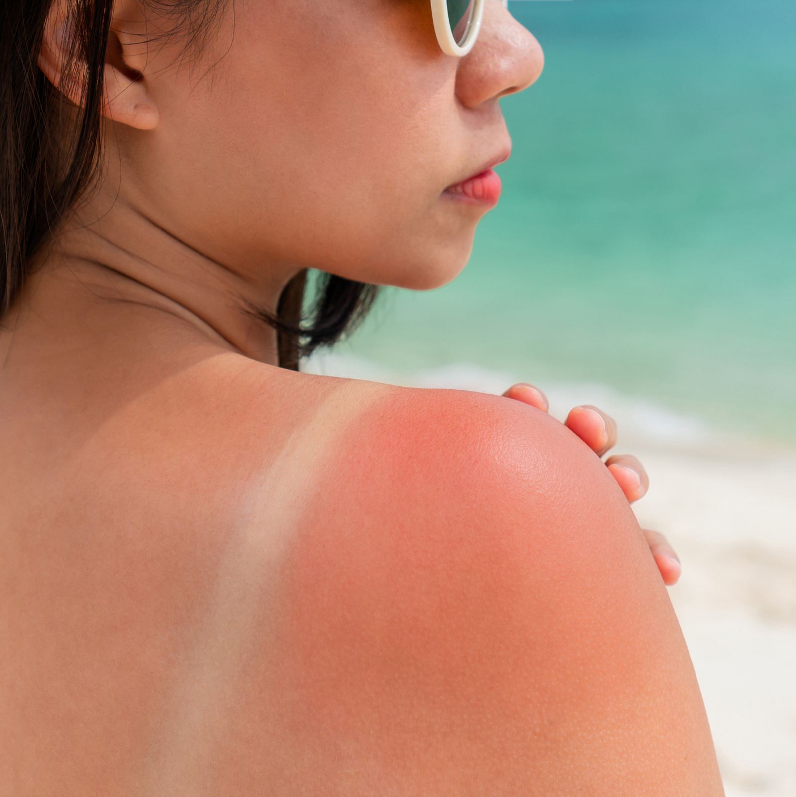 Schnelle Hilfe bei Sonnenbrand: Dieses Gel beruhigt gereizte Haut sofort |  Wunderweib
