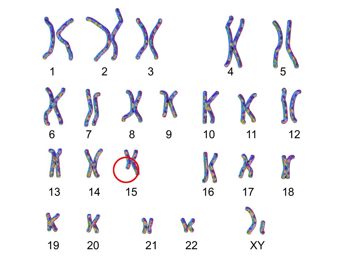 Angelman-Syndrom: Beim meist maternalen Chromosom 15 fehlt ein DNA-Abschnitt