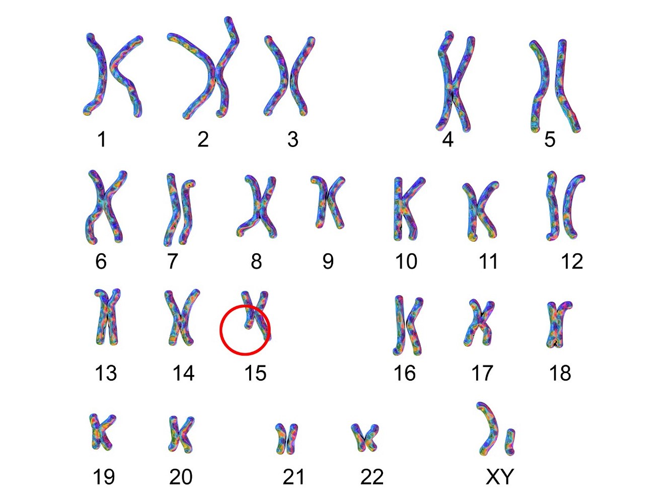 Angelman-Syndrom: Beim meist maternalen Chromosom 15 fehlt ein DNA-Abschnitt Angelman-Syndrom: Beim meist maternalen Chromosom 15 fehlt ein DNA-Abschnitt
