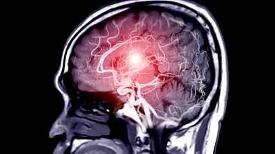 Aphasie: Ursachen, Symptome und Therapie der Sprachstörung - Foto: mr.suphachai praserdumrongchai/iStock