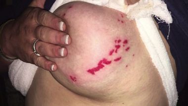 Diese schlimmen Verletzungen an den Brüsten sollen durch einen selbstklebenden BH verursacht worden sein. - Foto: facebook.com/JamilynMoran1