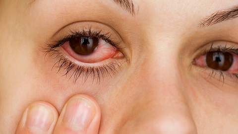 Diese vier Hausmittel helfen bei einer Bindehautentzündung. - Foto: iStock/offstocker