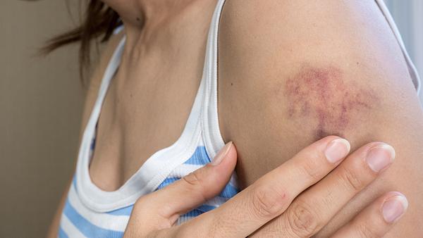 Frau mit blauem Fleck am Arm (Themenbild) - Foto: Ekaterina Zolina/iStock