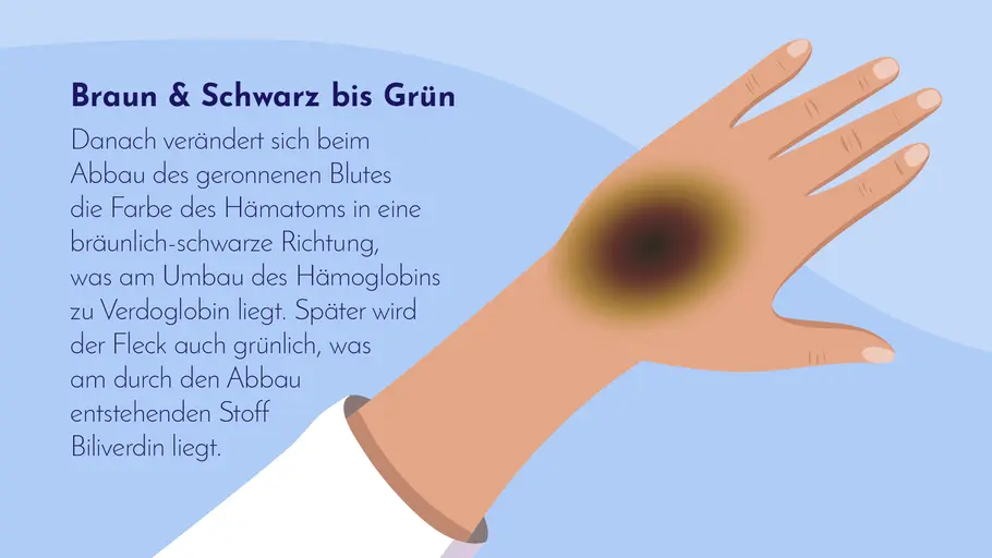 Braun & Schwarz bis Grün: Abbau des geronnenen Blutes. Braun & Schwarz bis Grün: Abbau des geronnenen Blutes.