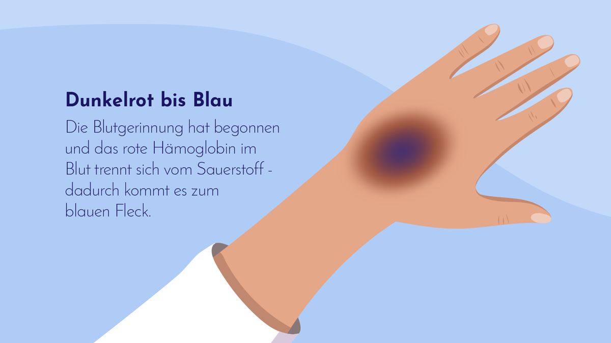 Dunkelrot bis Blau: Die Blutgerinnung hat begonnen.