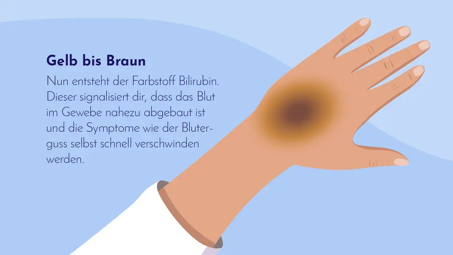 Gelb bis Braun: Der Bluterguss verschwindet bald. Gelb bis Braun: Der Bluterguss verschwindet bald.