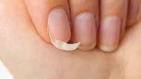 Brüchiger Fingernagel: Kommt es zum Einreißen, kann das durchaus schmerzhaft sein (Symbolbild). - Foto: Ilja Enger-Tsizikov/iStock Brüchiger Fingernagel: Kommt es zum Einreißen, kann das durchaus schmerzhaft sein (Symbolbild). - Foto: Ilja Enger-Tsizikov/iStock