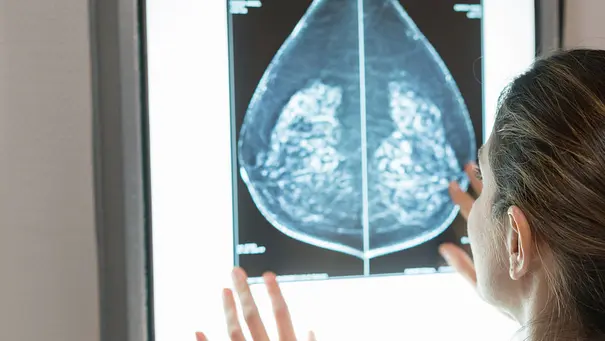 Zysten in der Brust sind meist harmlos. - Foto: iStock