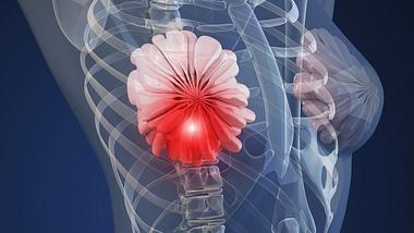 Krebs-Vorsorge: Warum du deine Brust auch im Liegen abtasten solltest - Foto: iStock