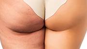 cellulite wundermittel artikel - Foto: Istock