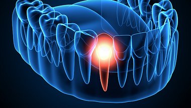 Corona: Parodontitis (chronische Zahnfleischentzündung) erhöht das Risiko für einen hohen Verlauf - Foto: Montage aus: Alona Siniehina/iStock & Bertrand Blay/iStock