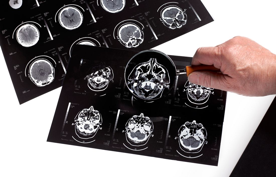 Studie bestätigt: Corona erhöht das Alzheimer-Risiko