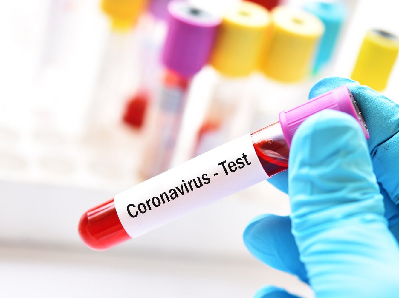Coronavirus: So kannst du dich testen lassen Coronavirus: So kannst du dich testen lassen