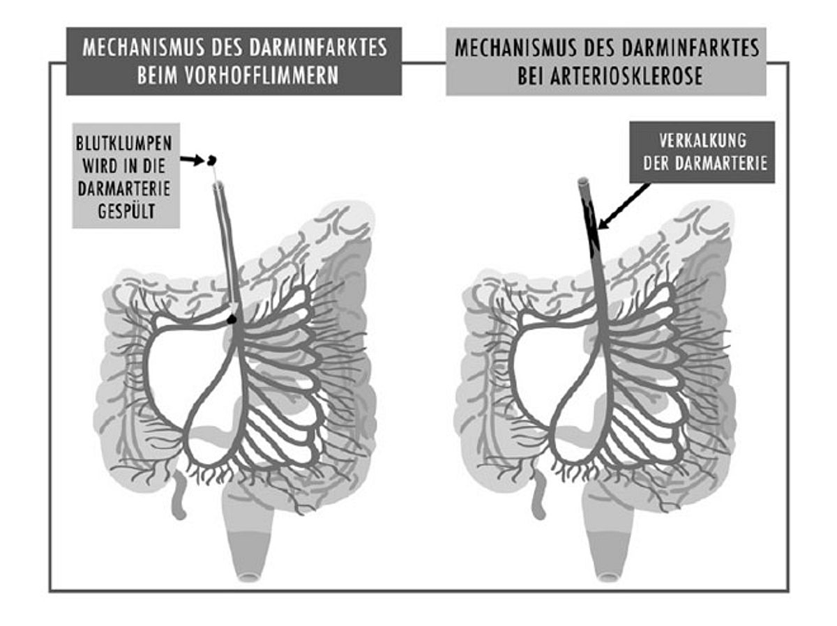 Der Darminfarkt entsteht durch einen Verschluss der Arterien durch Fremdkörper wie Blutklumpen oder Kalkablagerungen.