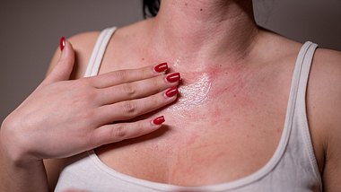 Gerötete Haut durch Duftstoffallergie - Foto: dtephoto/iStock