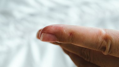 Dyshidrose-Ursachen bestimmen die Behandlung der juckenden Bläschen am Finger - Foto: Carmen Jost/iStock (Symbolfoto)