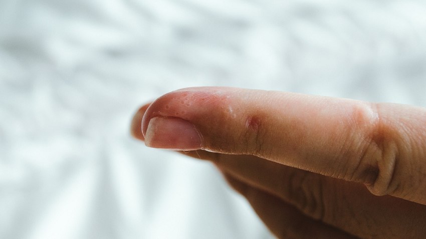 Finger einer Frau mit kleinen Bläschen (Themenbild) - Foto: Carmen Jost/iStock (Symbolfoto)