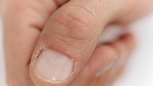 Eingerissene Nagelhaut kann schmerzhaft sein. (Symbolbild) - Foto: Albina Gavrilovic/iStock