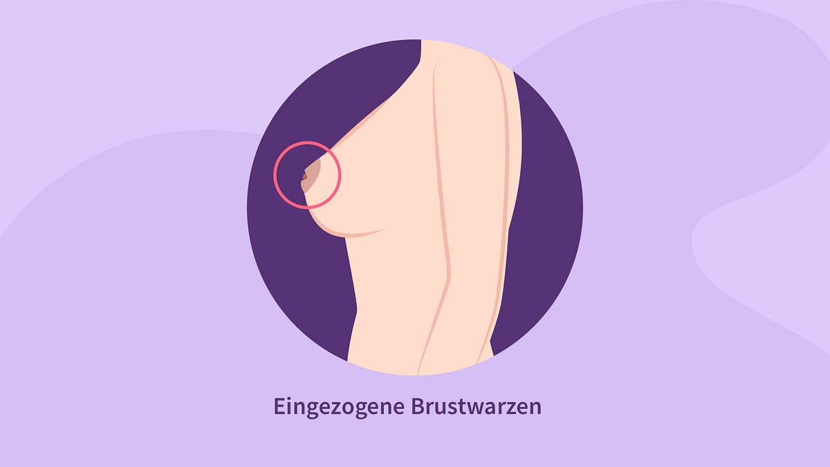 Eingezogene Brustwarzen können ein Anzeichen von Brustkrebs sein.