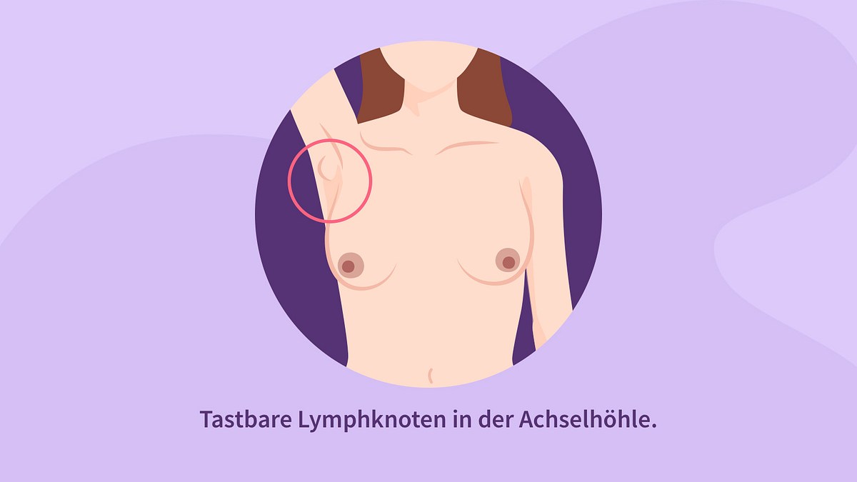 Ertastbare Lymphknoten