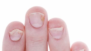 fingernaegel psoriasis - Foto: Istock