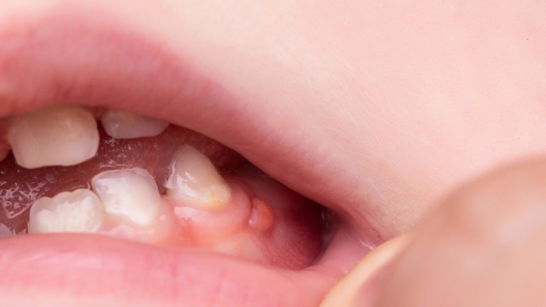 Fistel im Mund am Zahnfleisch: Darfst du Zahnfisteln ausdruecken? (Themenbild) - Foto: Henadzi Pechan/iStock
