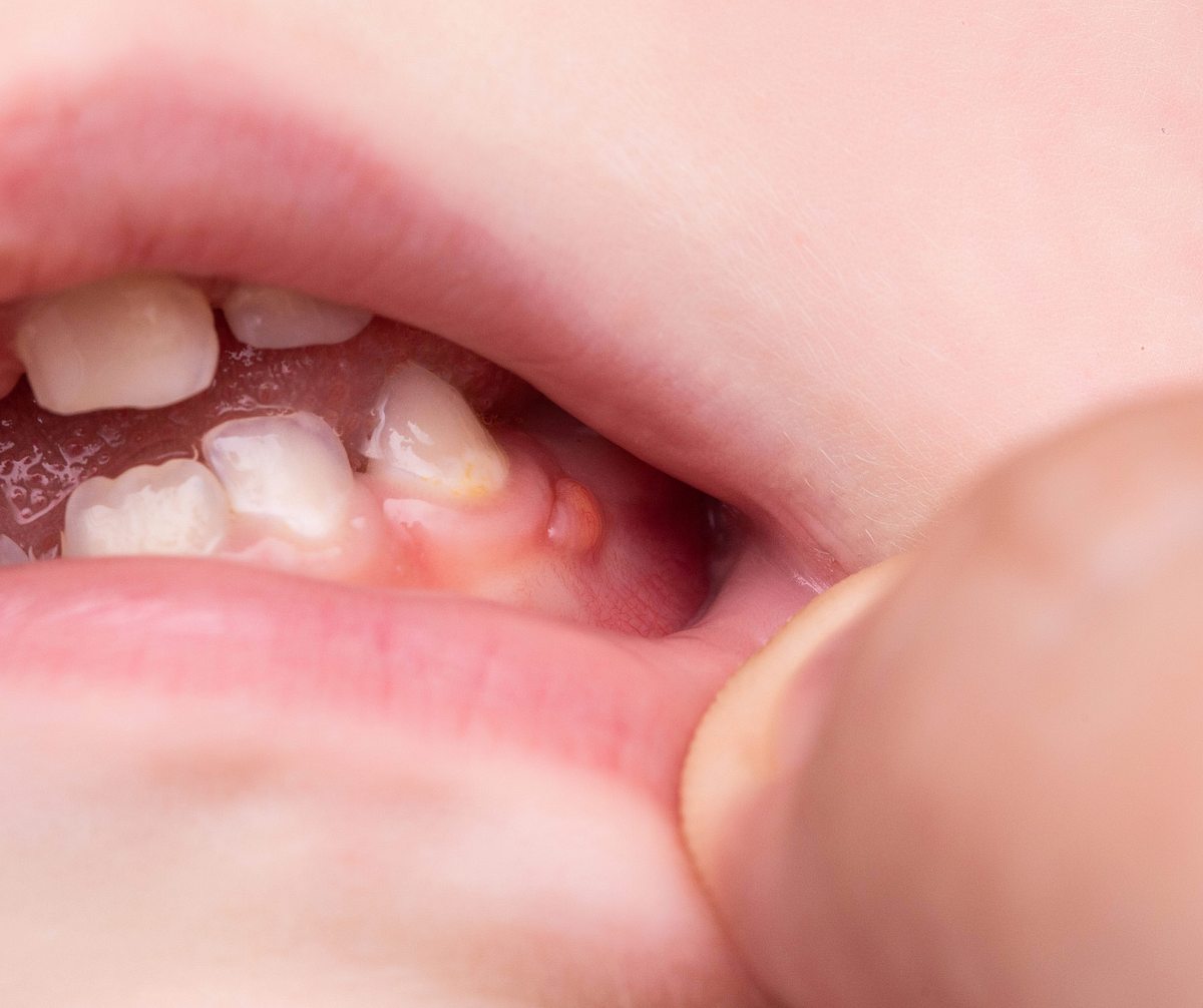 Fistel im Mund am Zahnfleisch: Darfst du Zahnfisteln ausdruecken? (Themenbild)