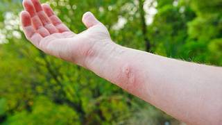Mückenstiche sind nie schön. Aber die Stiche von Gnitzen sind sogar noch gemeiner als die von Stechmücken. - Foto: iStock