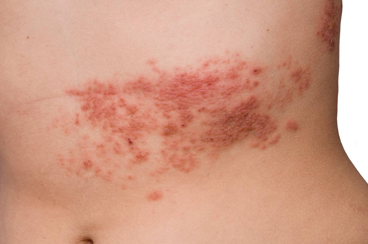 Stechende oder juckende Schmerzen sind die Symptome für Herpes Zoster. (Symbolbild)