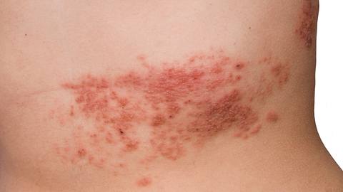 Stechende oder juckende Schmerzen sind die Symptome für Herpes Zoster. (Symbolbild) - Foto: franciscodiazpagador/iStock