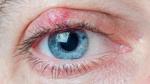 Hagelkorn am oberen Augenlid über einem blauen Auge (Themenbild) - Foto: Andrei310/iStock