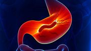 Das Bakterium Helicobacter pylori ist ein möglicher Auslöser für eine Magenschleimhautentzündung. - Foto: iStock