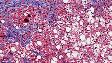 Hepatitis: Alles zur Übertragung, Impfung und zu Symptomen der Leberentzündung - Foto: iStock Hepatitis: Alles zur Übertragung, Impfung und zu Symptomen der Leberentzündung - Foto: iStock