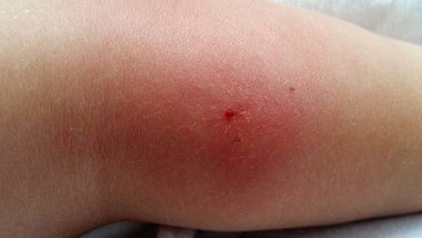 Einer Frau aus Köln mussten nach einer Blutvergiftung durch einen Insektenstich beide Beine und ein Arm amputiert werden. Jetzt will sie andere Menschen warnen. - Foto: iStock (Symbolfoto)