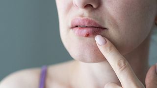 Lippenherpes in der Schwangerschaft - Foto: iStock/ Sinenkiy