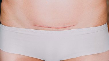 Kaiserschnittnarbe richtig pflegen: Tipps für die schnelle Heilung - Foto: iStock