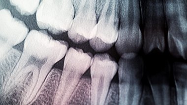Karies kann tödlich enden, wenn es um die Zähne ganz schlecht bestellt ist (Symbolbild) - Foto: nanoqfu/iStock