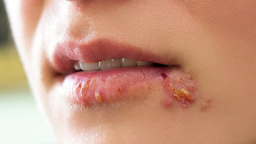 Knoblauch gegen Herpes: Das Hausmittel beugt den Lippenbläschen vor - Foto: CherriesJD/iStock