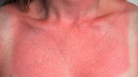 Diese Lebensmittel können Sonnenbrand auslösen - Foto: iStock