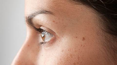 leberflecken ansteckend - Foto: Istock