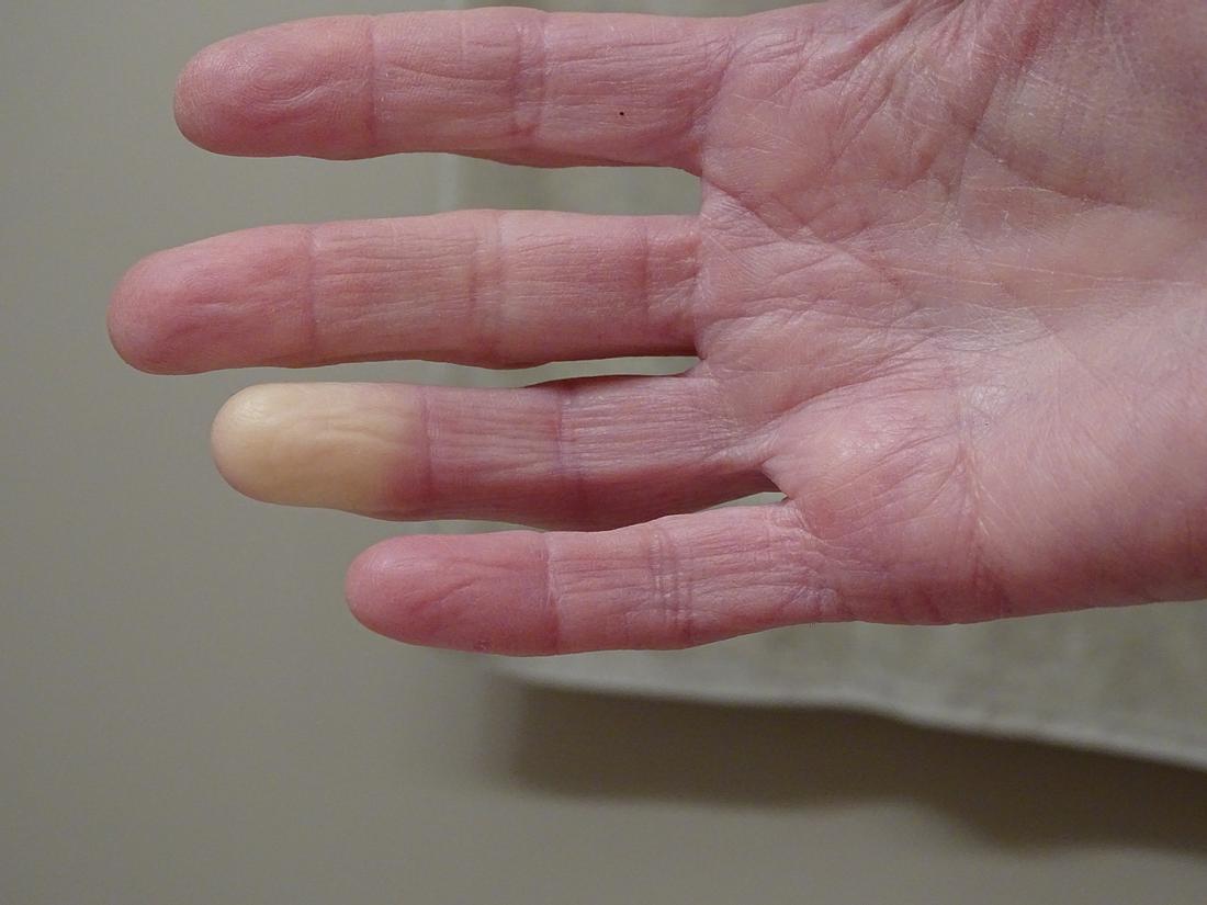 Raynaud-Syndrom: Symptome der Leichenfinger sind unter anderem die blasse Farbe und Taubheit. (Themenbild) Raynaud-Syndrom: Symptome der Leichenfinger sind unter anderem die blasse Farbe und Taubheit. (Themenbild)