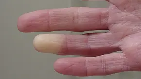 Raynaud-Syndrom: Symptome der Leichenfinger sind unter anderem die blasse Farbe und Taubheit. (Themenbild) - Foto: Barb Elkin/iStock Raynaud-Syndrom: Symptome der Leichenfinger sind unter anderem die blasse Farbe und Taubheit. (Themenbild) - Foto: Barb Elkin/iStock