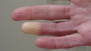 Raynaud-Syndrom: Symptome der Leichenfinger sind unter anderem die blasse Farbe und Taubheit. (Themenbild) - Foto: Barb Elkin/iStock