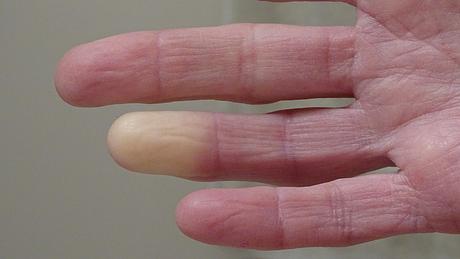 Raynaud-Syndrom: Symptome der Leichenfinger sind unter anderem die blasse Farbe und Taubheit. (Themenbild) - Foto: Barb Elkin/iStock